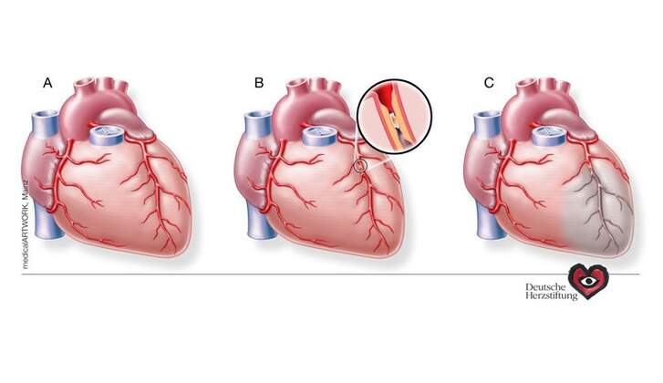 Herzinfarkt Vorbeugen So Kannst Du Vorbeugen Men S Health
