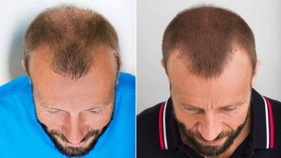 Haartransplantation So Lauft Eine Haarverpflanzung Ab Men S Health