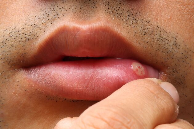 Am heilt nicht mund herpes Lippenherpes (Herpes