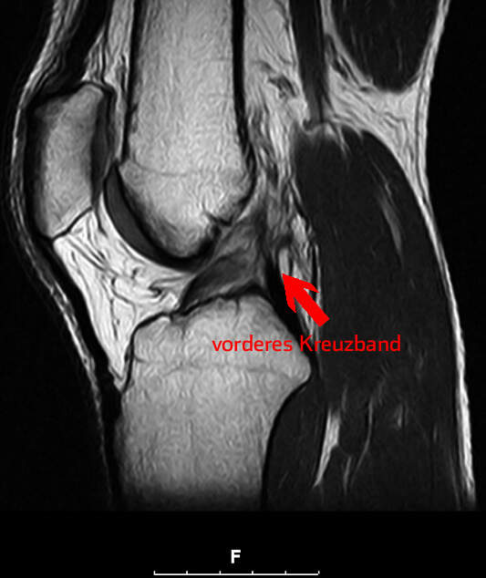 Das Kreuzband stabilisiert das Knie und hält es zusammen