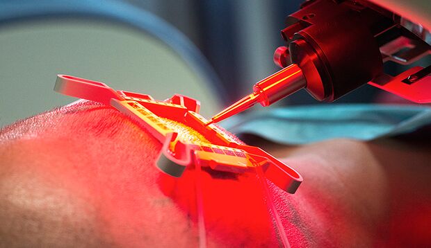 Der Haartransplantations-Roboter entnimmt Haarfollikel aus dem Hinterkopf