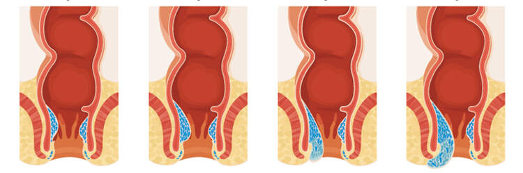 Hamorrhoiden Ursachen Und Behandlung Men S Health
