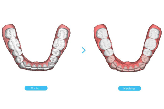 Die Zähne im Vorher-Nachher-Vergleich