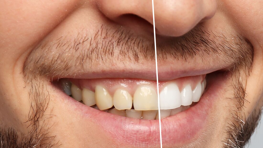 Die besten Bleaching-Produkte für weiße Zähne