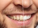 Die besten Bleaching-Produkte für weiße Zähne