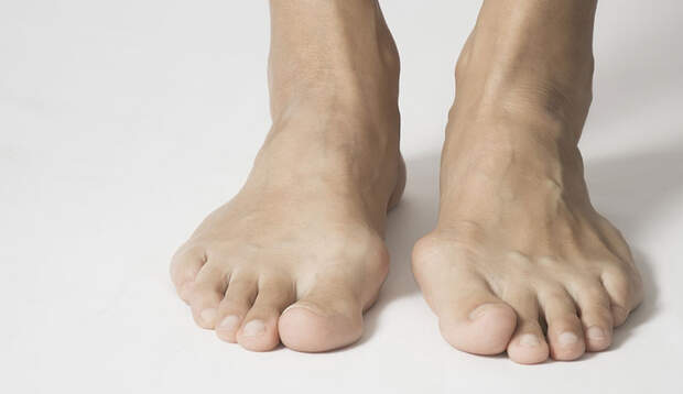Ein verformter Großzehknochen (Hallux valgus) kann Fußschmerzen auslösen