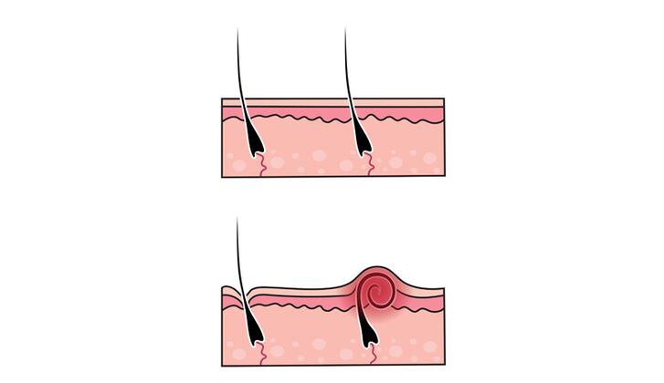 Narben am bein vom rasieren