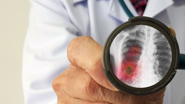 Erst ein Röntgenbild bringt bei Lungenkrankheiten eine sichere Diagnose.