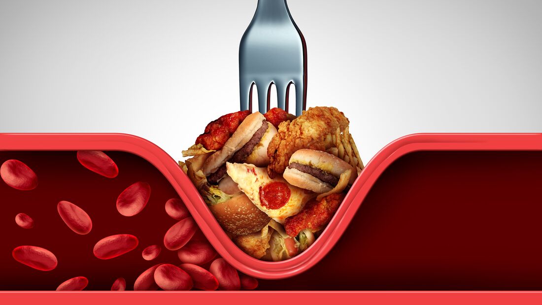 Fettige Lebensmittel fördern Cholesterin-Ablagerungen in den Arterien, es entstehen Engstellen, die zu Herzinfarkten führen können.