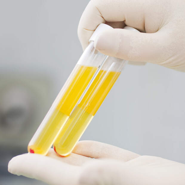 Für die PRP-Therapie wird nur das Blutplasma verwendet