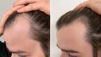 PRP-Behandlung gegen Haarausfall im Test
