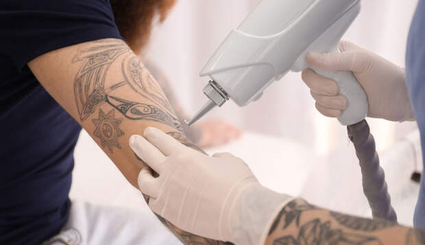 Per Laser lassen sich Tattoos am sichersten entfernen